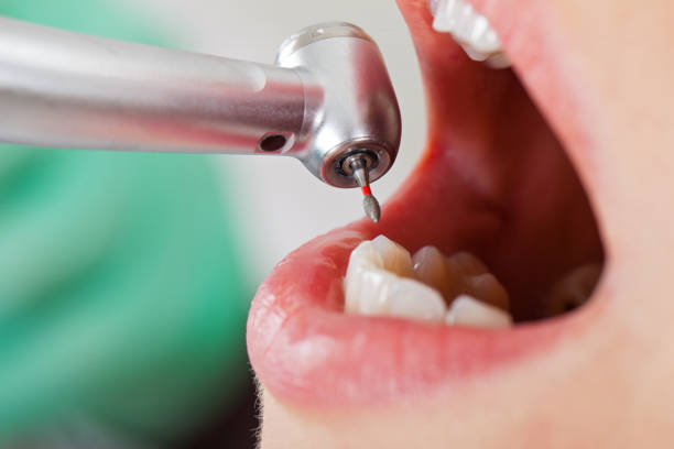 Best Urgent Care for Lost Fillings or Crowns in Morristown, IN